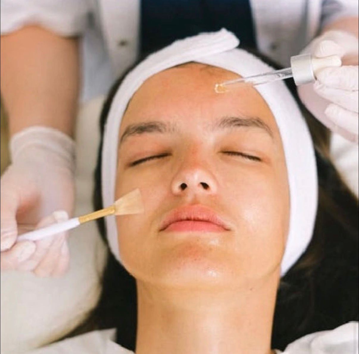 The Benefits of Chemical Peels