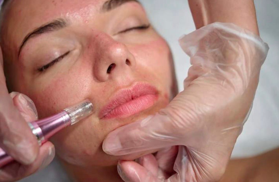 The Benefits of Microneedling